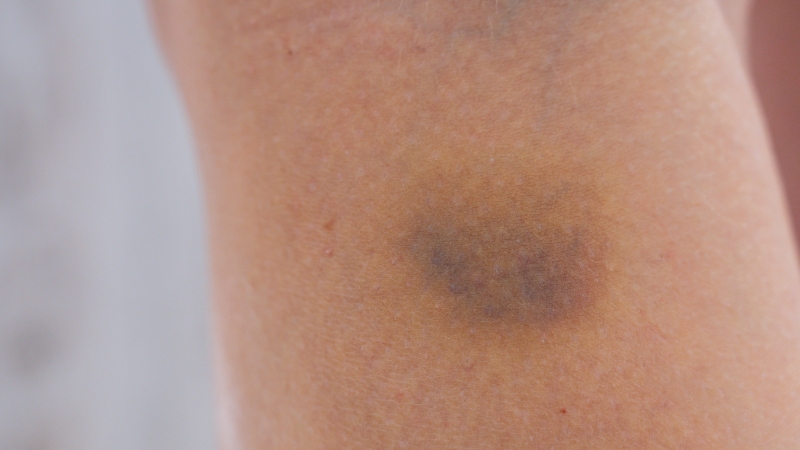 Modrica na koži ruke, tamnoplave i braon nijanse