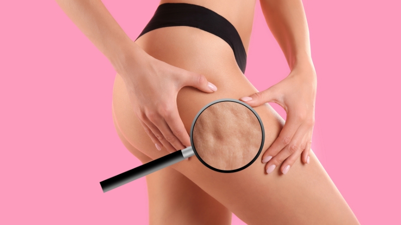 Žena rukama dodiruje butinu sa vidljivim celulitom, uz uvećani prikaz strukture kože