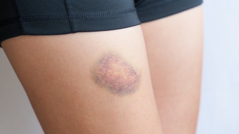 Modrica na butini u fazi oporavka, sa mešavinom žutih i ljubičastih tonova