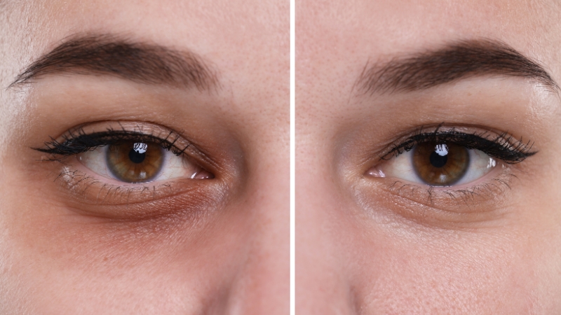 Pre i posle prikaz područja oko očiju gde su podočnjaci i kesice vidno smanjeni