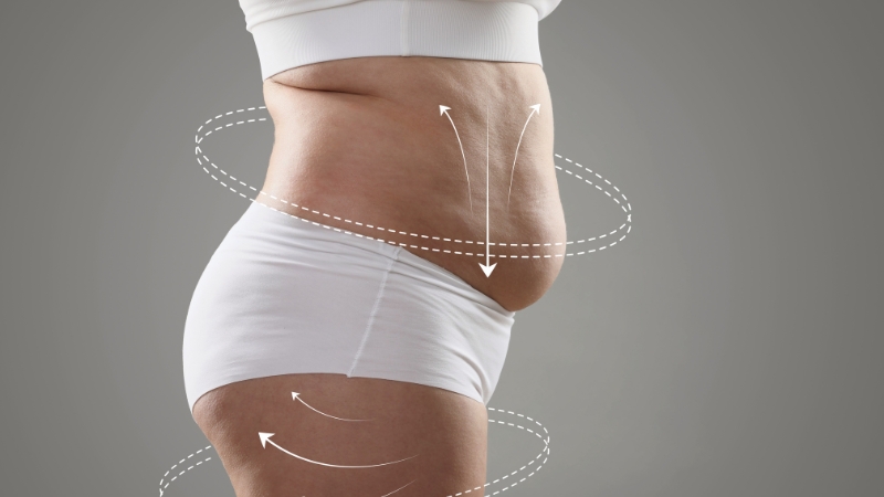 Prikaz stomaka sa naglašenim masnim naslagama i označenim zonama tretmana lipolize