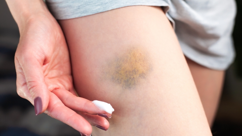 Modrica na butini u fazi zarastanja, žuto-ljubičaste boje, dok žena nanosi kremu na kožu